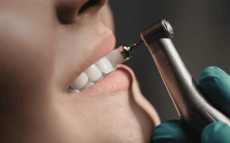 Dental professional performing a teeth cleaning with precision tool