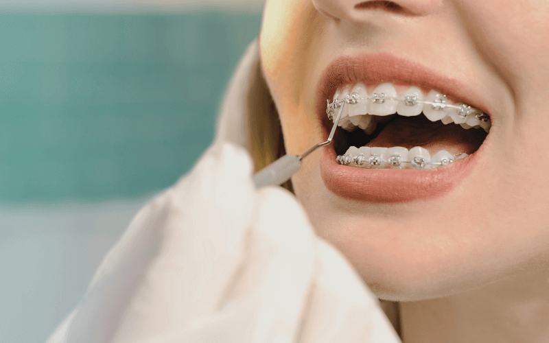 Close-up of patient with braces during orthodontic treatment in Mississauga clinic