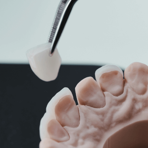 Close-up of a dental crown being placed on a tooth model.