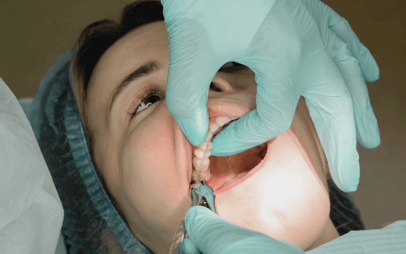 Dentist performing a wisdom tooth extraction on a patient